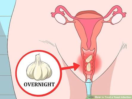 garlic and vaginal yeast infection Garlic and vaginal yeast infection